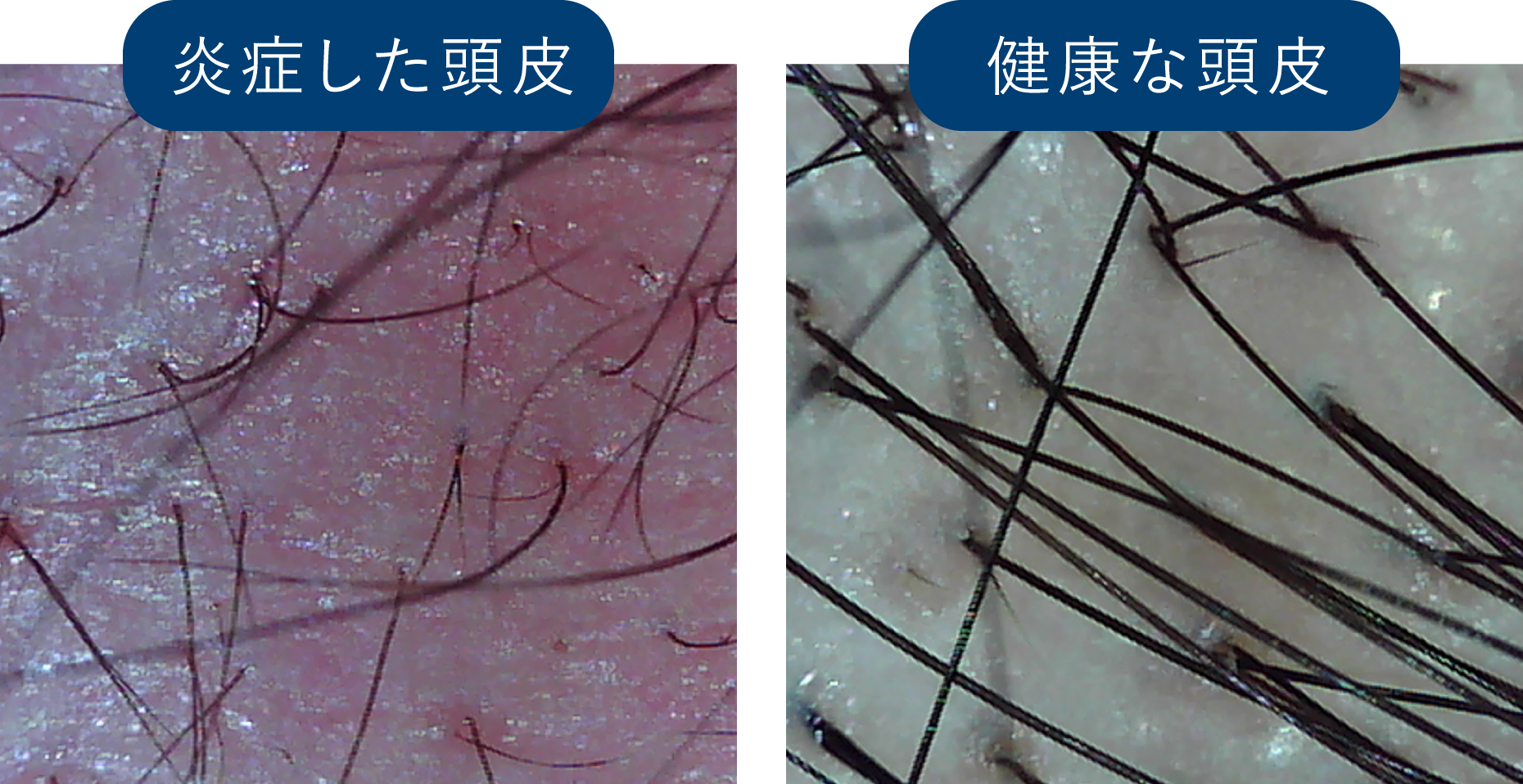炎症した頭皮・健康な頭皮